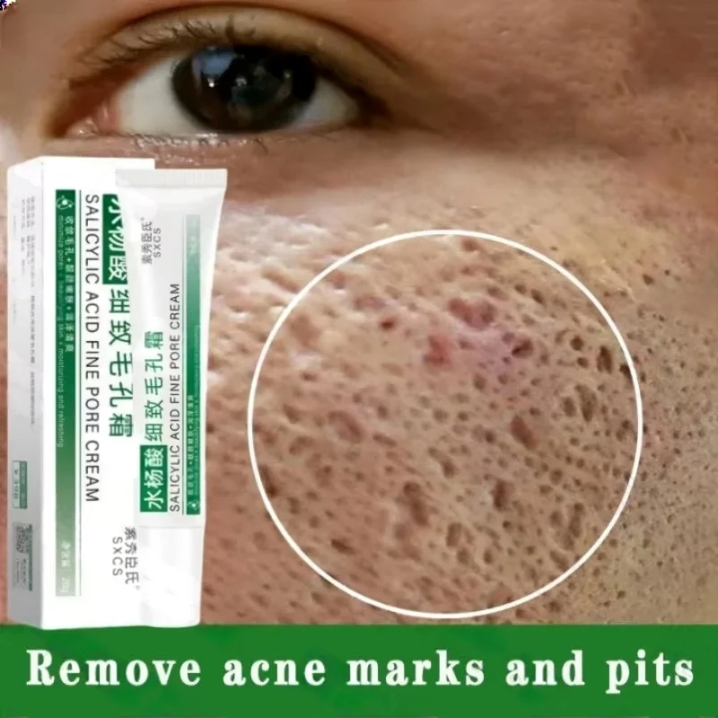 Azelaic Acid Cream - Krim Pembersih Pori Asam Salisilat Mengecilkan