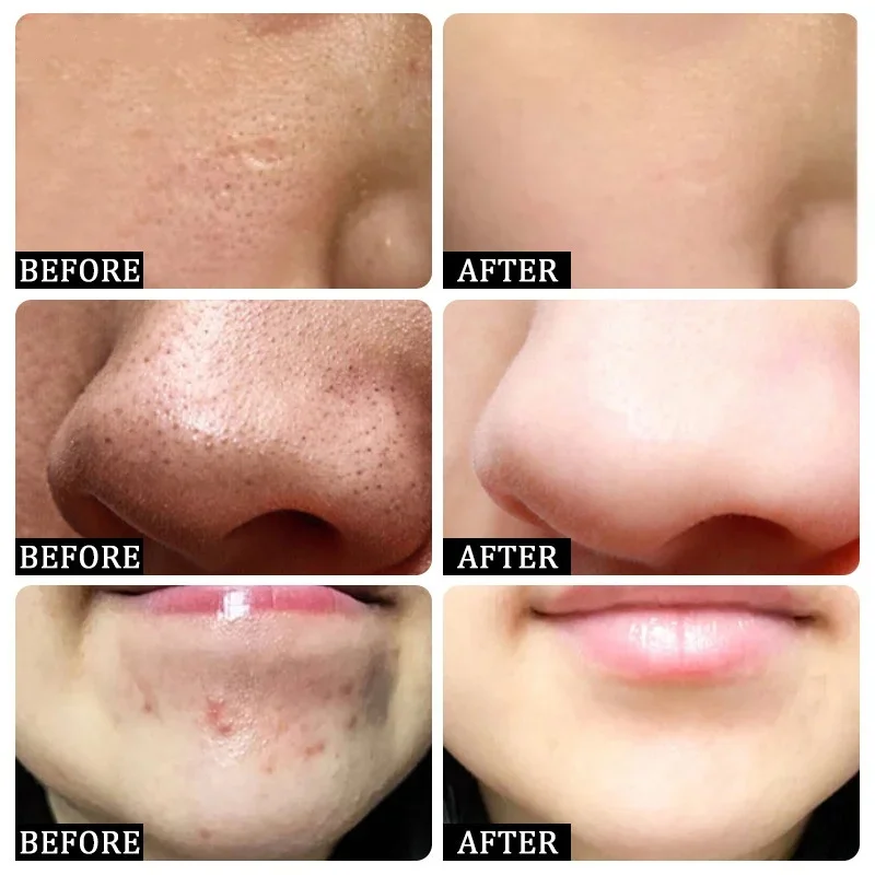 Krim Pembersih Pori Asam Salis - Azelaic Acid Cream ulasan dan harga