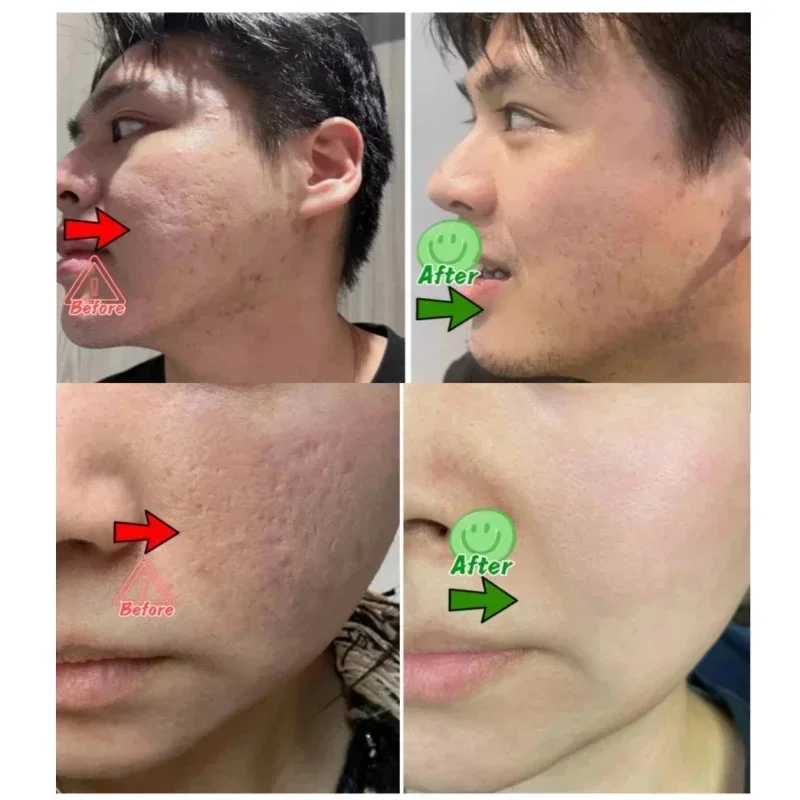 Krim Pembersih Pori Asam Salis - Azelaic Acid Cream ulasan dan harga