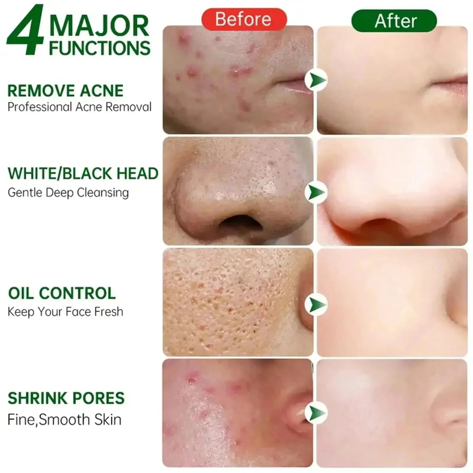 Krim Pembersih Pori Asam Salis - Azelaic Acid Cream ulasan dan harga