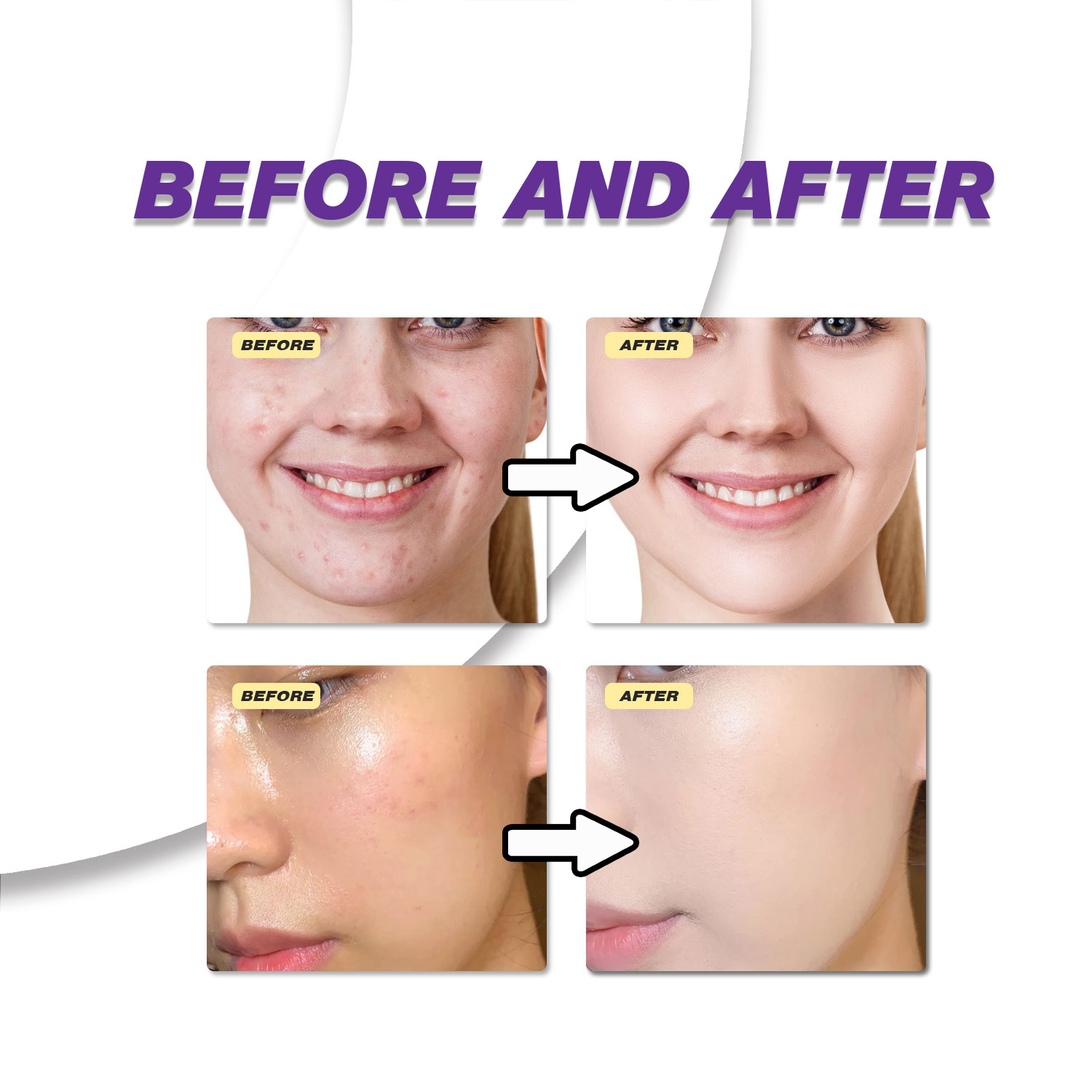 Krim Asam Azelaat Ringan Menin - Azelaic Acid Cream ulasan dan harga