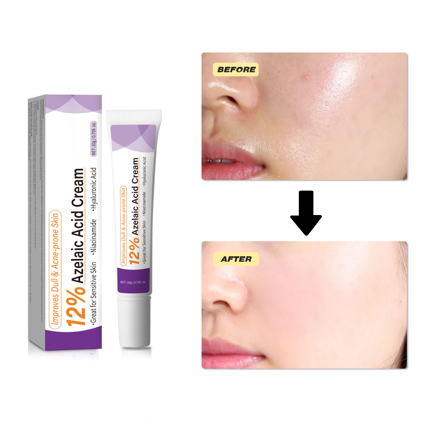 Krim Asam Azelaat Ringan Menin - Azelaic Acid Cream ulasan dan harga